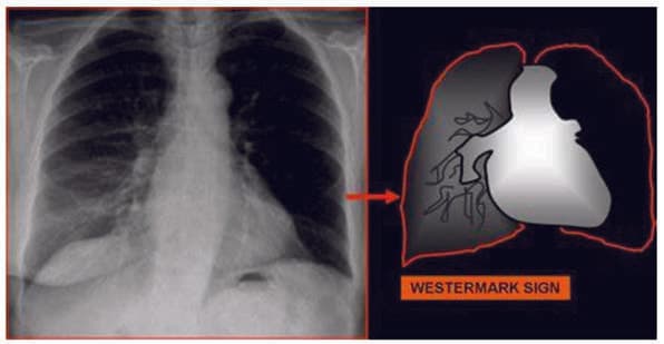 Westermark İşareti — resim 3