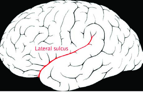 Sylvian Fissür(lateral fissür).
