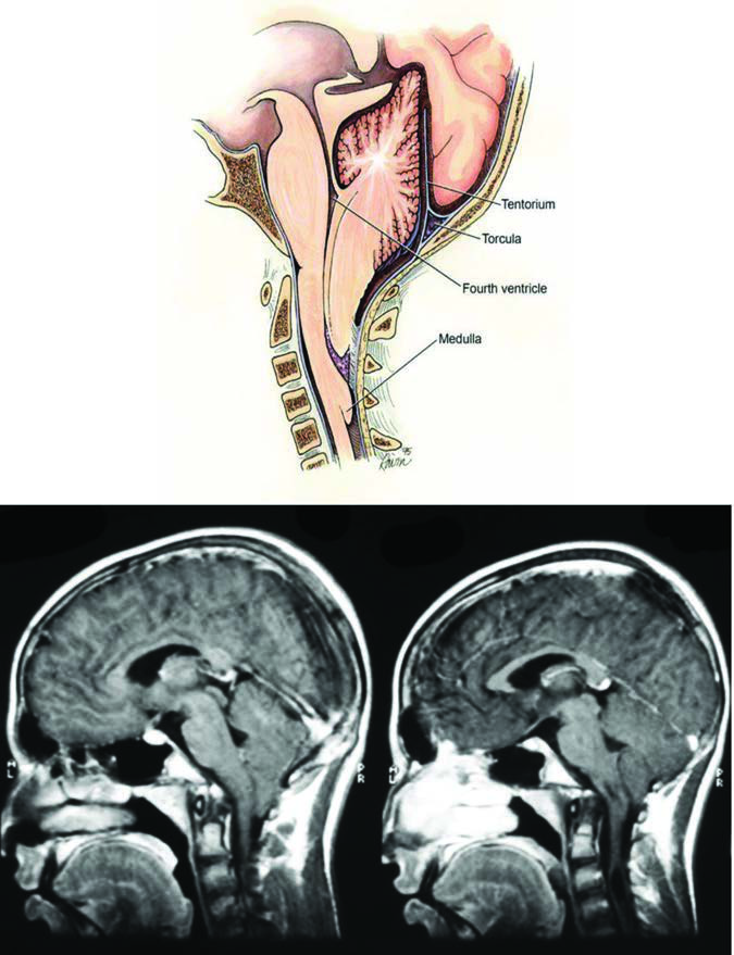 Arnold-Chiari Malformasyonu — resim 3