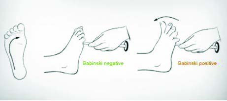 Babinski Bulgusu — resim 2