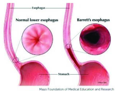 Photo Courtesy: Mayo Foundation for Medical  Education and Research