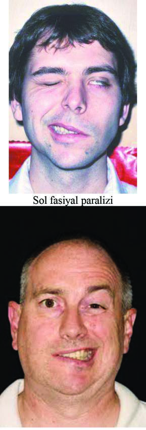 Bell Paralizisi — resim 2