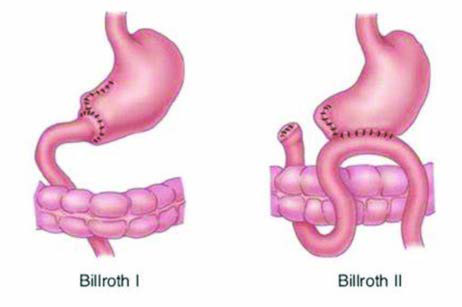 Billroth Ameliyatları — resim 2