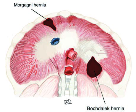 Bochdalek Hernisi — resim 2