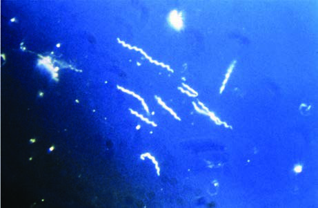 Borrelia Burgdorferi — resim 3