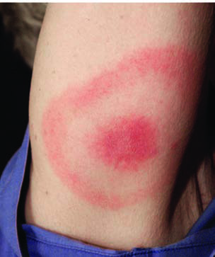 Borrelia Burgdorferi — resim 4