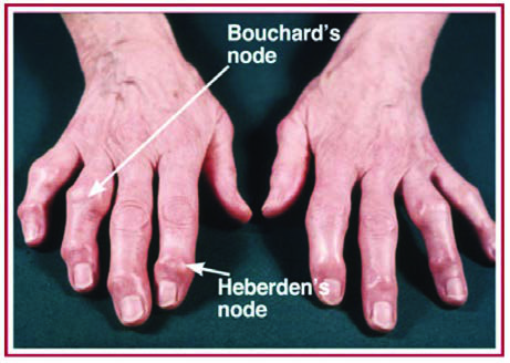 Bouchard Nodülleri — resim 2