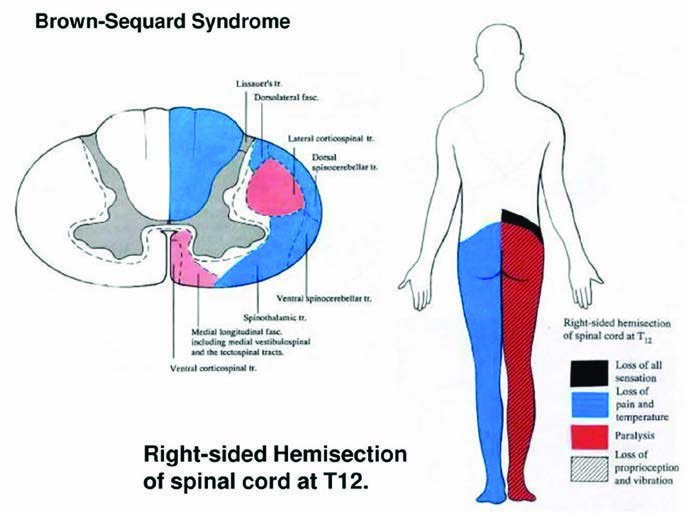Brown-Séquard Sendromu — resim 3