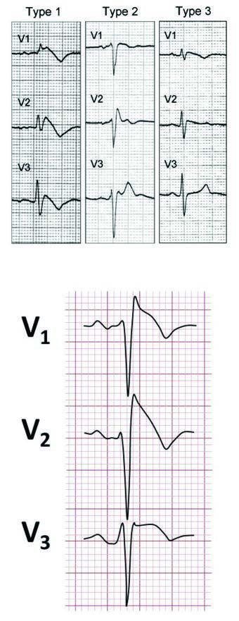 Prekordiyal derivasyonlardan V1, V2 ve V3’ten tipik 12  derivasyonlu EKG tip 1 Brugada sendromu görünümü