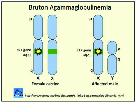 Bruton Agammaglobulinemisi — resim 2