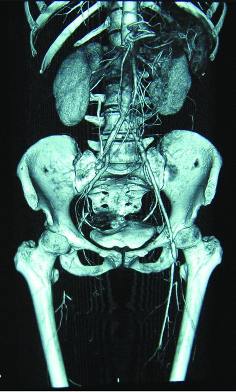 Tromboanjiitis obliterans’ın CT görüntüsü. Sağda tam  oklüzyon ve sol femoral arter stenozu