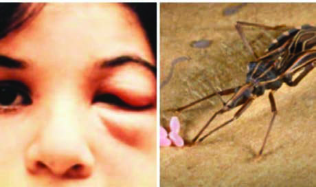 T. cruzi’nin ortak vektörü olan Triatoma infestans ve  ısırılan bölgedeki şişlik