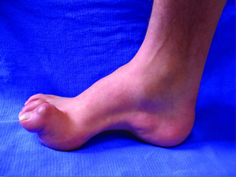 Charcot-Marie-Tooth Hastalığı — resim 3