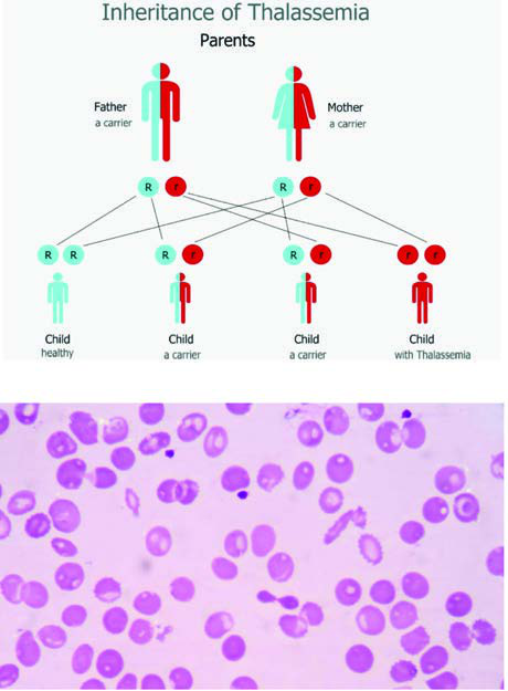 Beta talasemili bir kişinin periferik kan yayması. Kırmızı  kan hücreleri şekil ve boyut olarak büyük farklılıklar gösterir ve  bazıları düşük hemoglobin içeriğinden dolayı boş görünür. (Giemsa boyası)