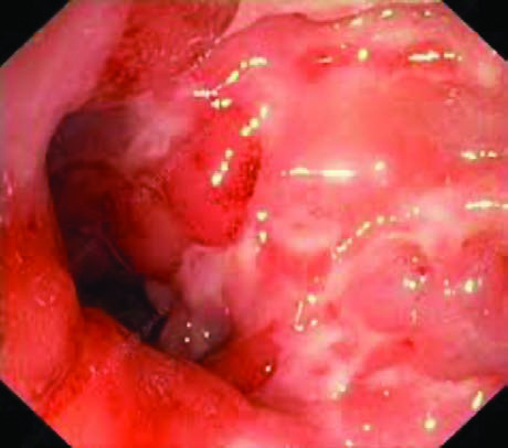 Crohn Hastalığı — resim 3