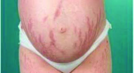 Abdominal Strialar