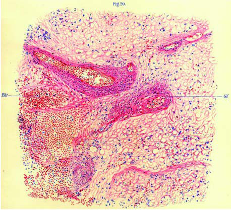 Enfekte bir maymundan alınan Corpus striatum  (hematoksilen-eozin, × 128). Kısaltmalar: Blt, perivasküler kanama;  Gf, sızmış damar.