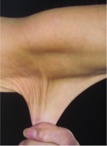 Ehlers-Danlos Hastalığı — resim 3