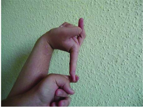 Ehlers-Danlos Hastalığı — resim 4