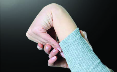 Ehlers-Danlos Hastalığı — resim 5