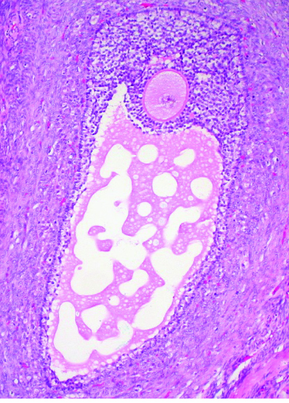 Olgun bir yumurtalık folikülünün histoloji bölümü.  Oosit, görüntünün üst merkezindeki büyük, yuvarlak, pembe  lekeli hücredir.Graafian Follicle, Human Over Ovary Patolojik ve  histolojik görüntüler Flickr’da Ed Uthman’ın izniyle.