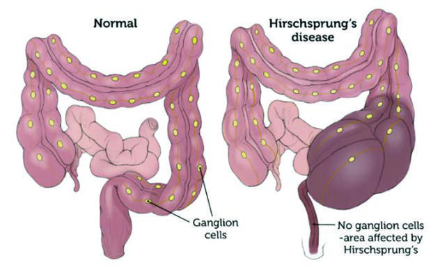 Hirschsprung Hastalığı — resim 2