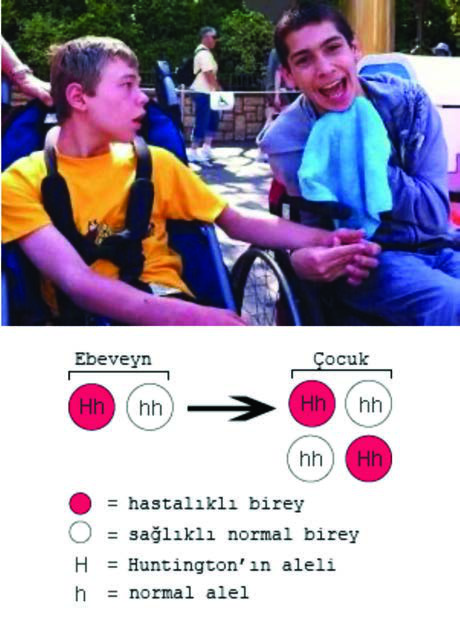 Huntington Hastalığı — resim 2