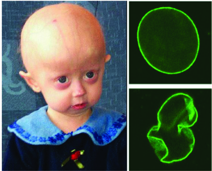 Hutchinson-Gilford Progeria Sendromu. HGPS, hücre  çekirdeğinin ana mimari proteinlerinden birindeki mutasyonların  neden olduğu bir çocukluk çağı hastalığıdır. HGPS hastalarında  hücre çekirdeği, tipik olarak sağlıklı bireylerde (üstte, sağda)  bulunan tek tip şekil yerine çarpıcı biçimde anormal morfolojiye  (altta, sağda) sahiptir.