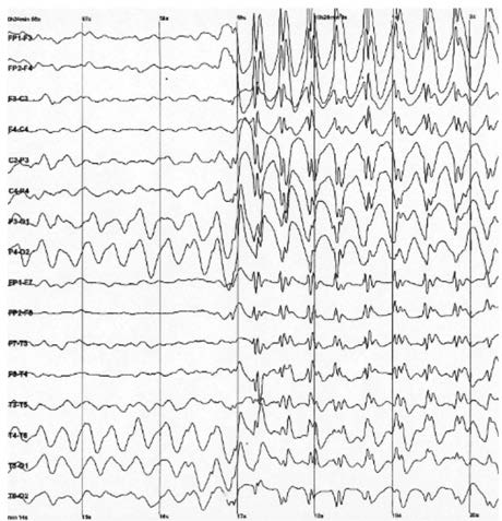 Sivri dalgalar (spike-waves).