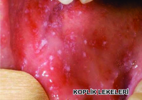 Koplik Lekeleri — resim 2