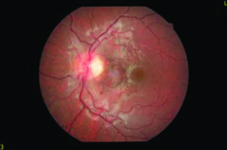Leber Herediter Optik Nöropati — resim 2