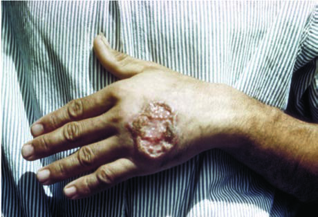 Orta Amerika yetişkininin eli olan leishmaniasis’e  bağlı cilt ülseri.