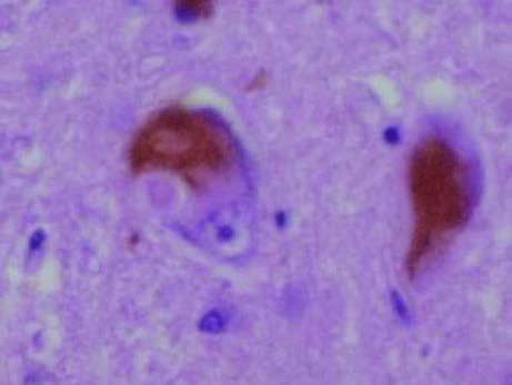 Lewy cisimleri