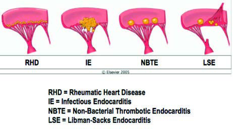 Libman-Sacks Endokarditi — resim 5