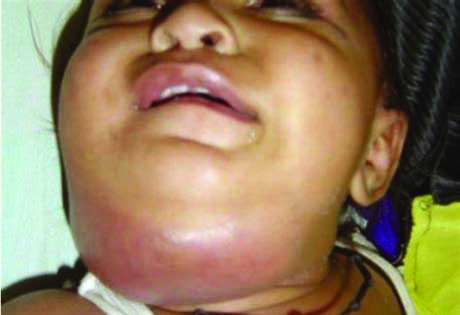 sillektomi, peritonsiller abse, mandibulanın kompleks  kırıkları ve infekte orofarinks kanserleri etyolojide bildirilen diğer nedenlerdir.