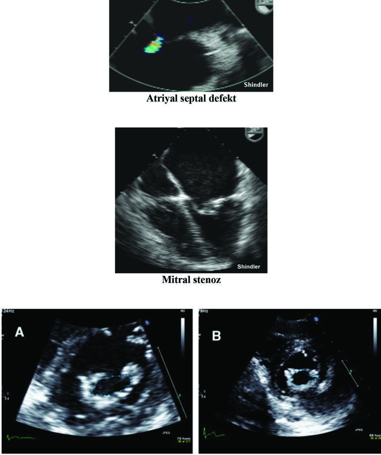Mitral stenoz kısa eksen görünümü.