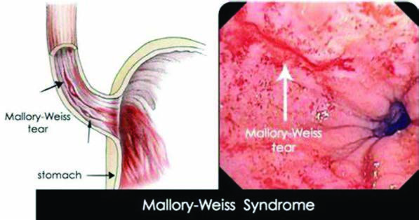 Mallory-Weiss Sendromu — resim 3