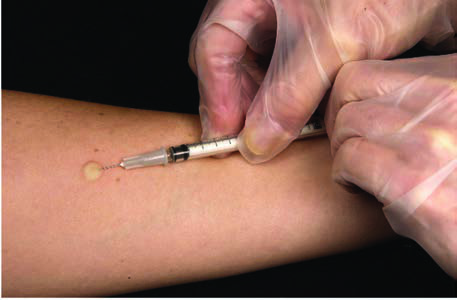 Mantoux Testi — resim 2