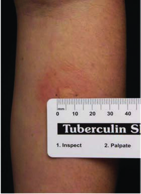 Mantoux Testi — resim 3