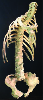 Heilbronn bölgesinden ankilozan spondilitli omurga,  6. yüzyılın başlarında, Landesmuseum Württemberg, Stuttgart,  Almanya’da gösterilmiştir.
