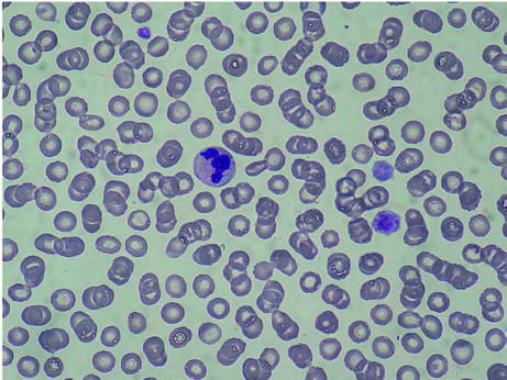 May-Hegglin anomalisi: lökosit sitoplazmik inklüzyon  (Döhle cisimlerine benzeyen bazofilik) ve dev trombositler.