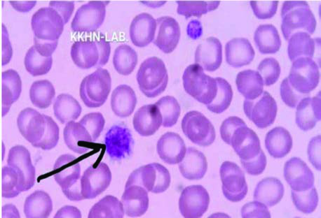 May-Hegglin Anomalisi — resim 3