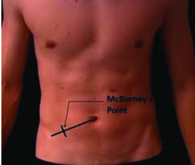 McBurney Noktası — resim 2