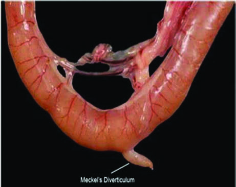 Meckel Divertikülü — resim 3