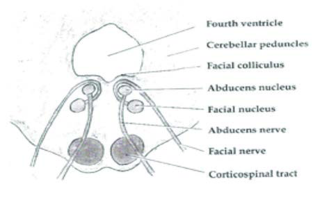 Fasial Colliculus seviyesinde beyin sapının (pons) eksenel  bölümü. Fasiyal sinirin (CN7) somatik motor liﬂerinin abdusens  çekirdeğinin (CN6) etrafında döndüğü gösterilmiştir.