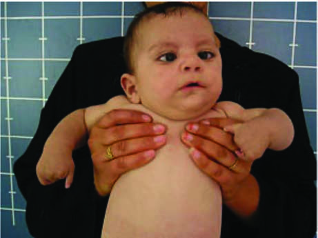 Resimde Oromandibular uzuv hipogenezi-Möbius  sendromu olan bir çocuk. İfadesiz yüze (bilateral VII sinir felci  nedeniyle) ve eksik parmaklar dikkat çekmektedir.