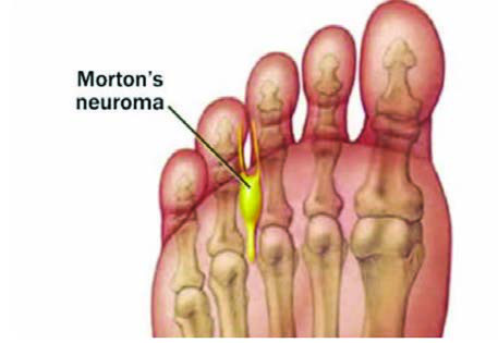 Morton Nöroma — resim 2