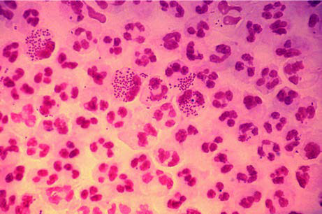 Neisseria Gonorrhea — resim 2