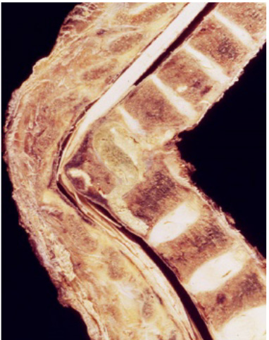 Borys D. Tuberculous osteomyelitis.