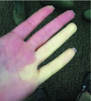 Bir hastalık alevlenmesi sırasında Raynaud sendromlu bir  kişinin eli.